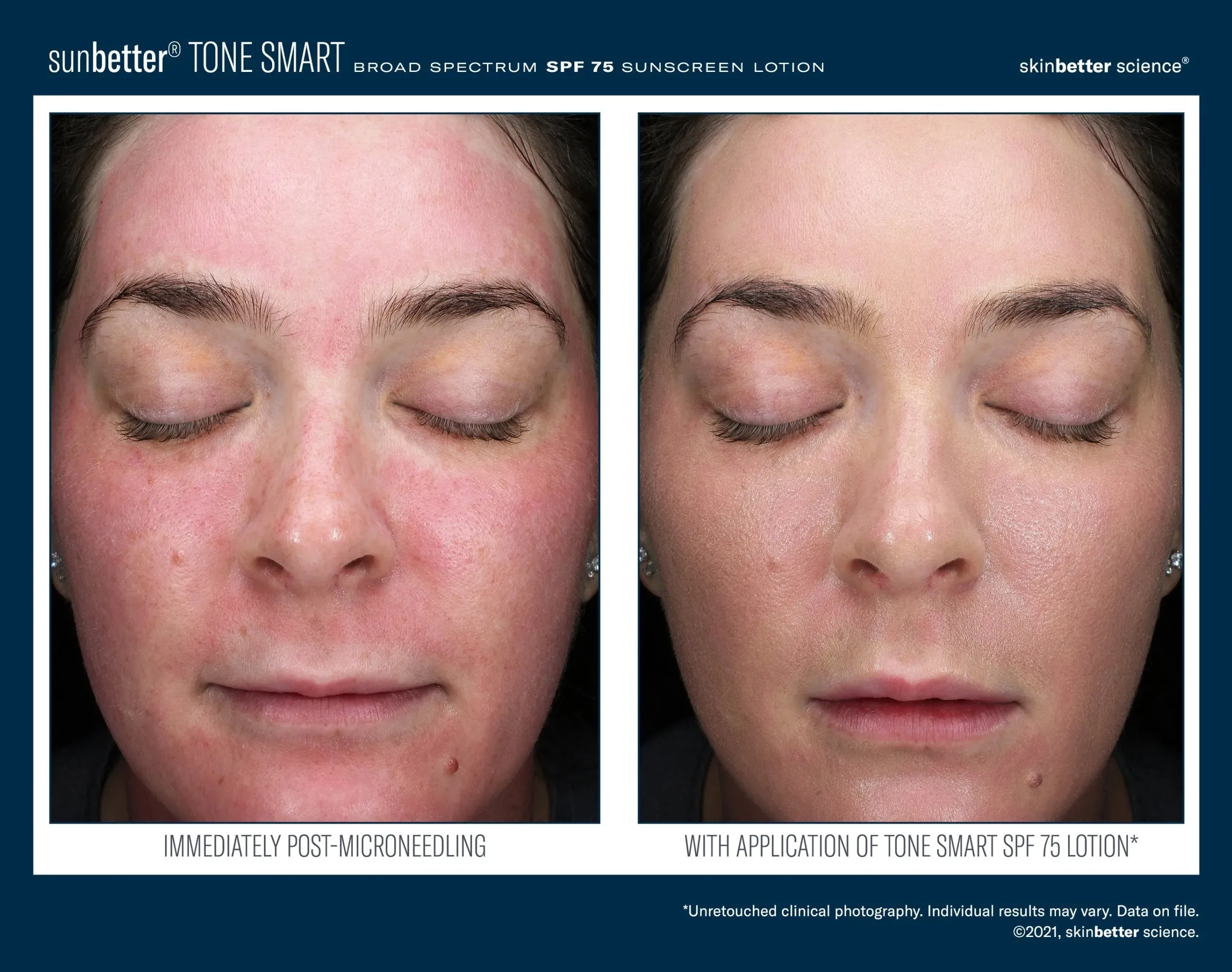 SKINBETTER Tone Smart SPF 75 Sunscreen Lotion